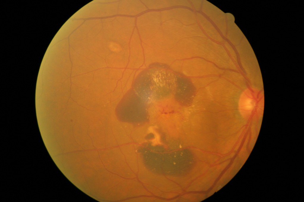 צילום קרקעית העין אצל חולה עם ניוון רשתית