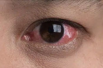 עיניים אדומות, עין אדומה